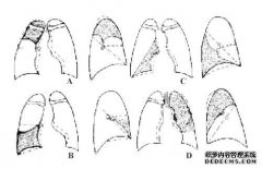 一个人的左右肺有几片叶子。