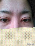 我想问一下如果眼睑完全割开并且疤痕消失了怎