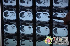 16线ct螺旋和64线ct螺旋有什么区别？