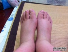 “怀孕37周后，我的全身充血会怎样！他们说..