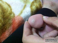 如果醋腐蚀了我的脸怎么办？你怎么能治愈？是