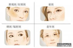 [班立静]生气的女人喜欢长处吗？如何去除黄褐斑