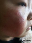 他们不小心袭击了我，我的脸受伤了，我该如何