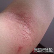 婴儿患有米疹超过3个月如何治疗？