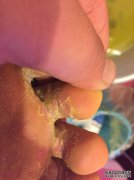 使用珊瑚后，完成。死皮不会褪色。喔...