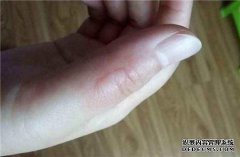 如果手指烧伤该怎么办？