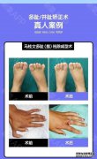 偏瘫切除